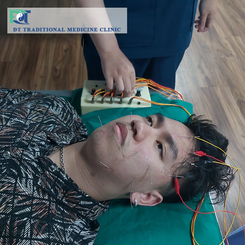 Điều trị liệt dây thần kinh số 7 ngoại biên an toàn hiệu quả tại Hà Nội.